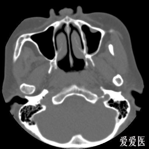 鼻咽部ct