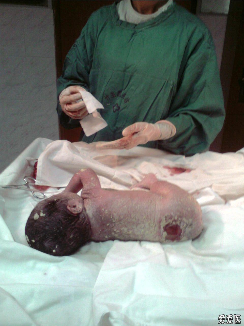 新生儿脊柱裂图片图片