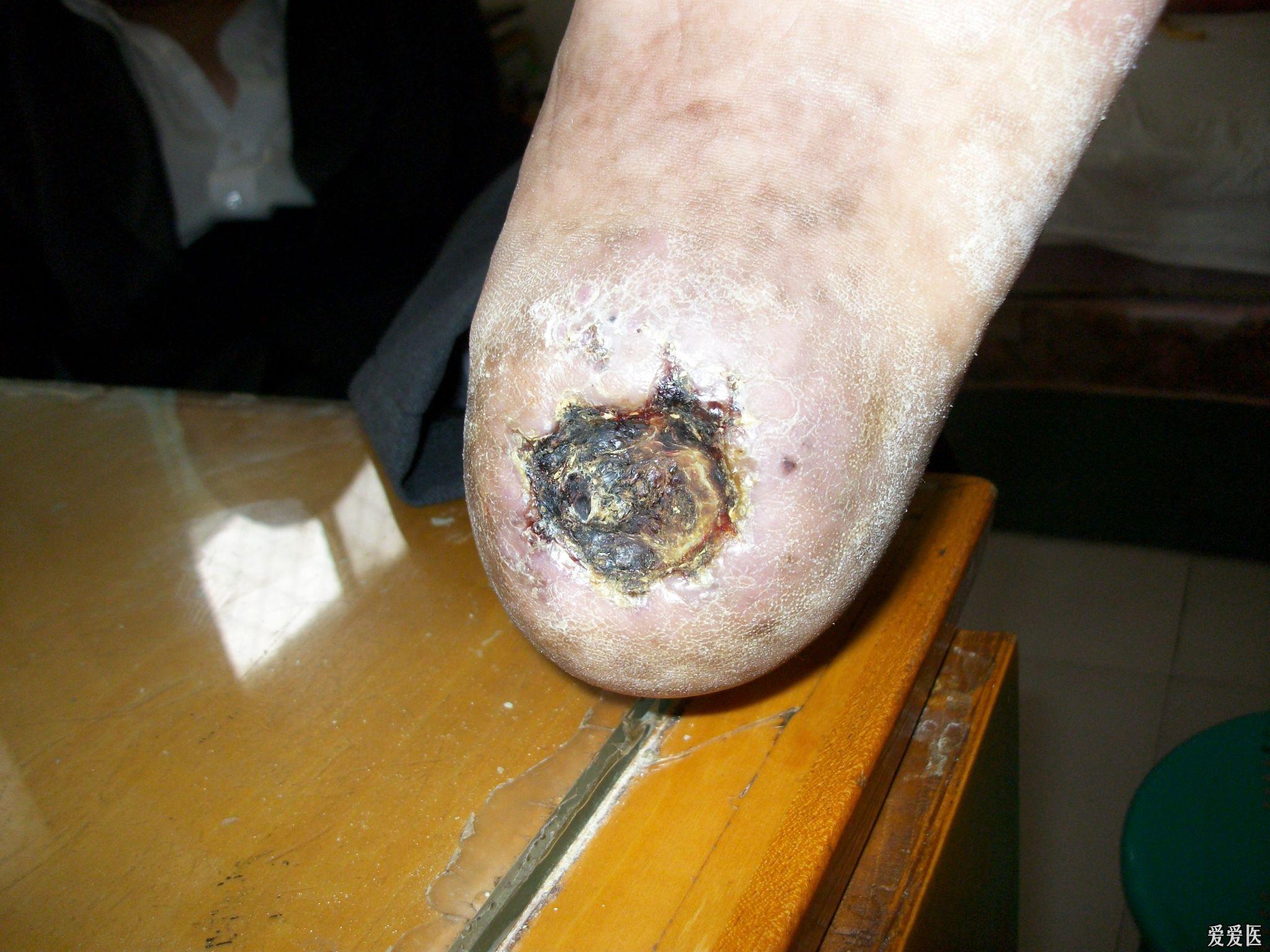 跪求伤口愈合良方