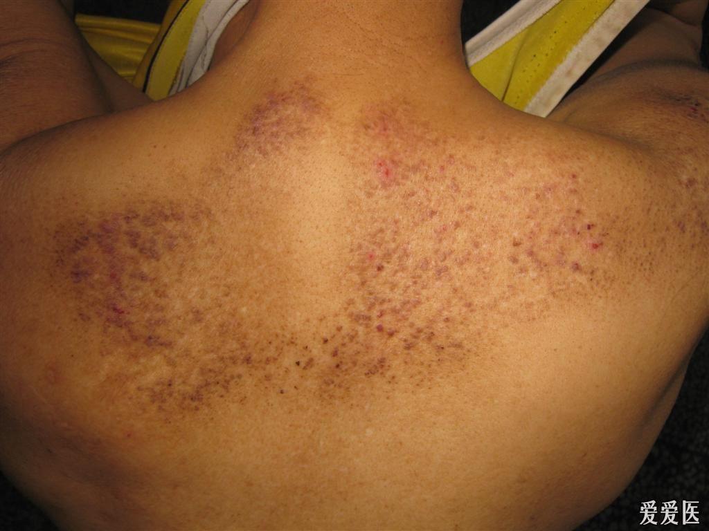 看图识病原发性皮肤淀粉样变