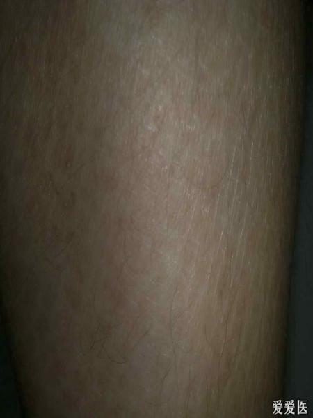 右前臂（曝光不好，看侧边）
