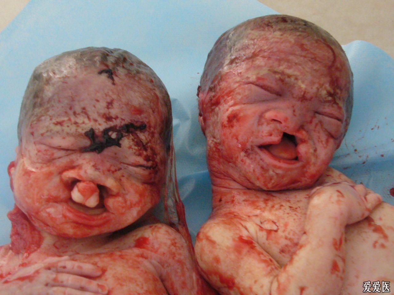 六个月胎儿唇腭裂图片图片