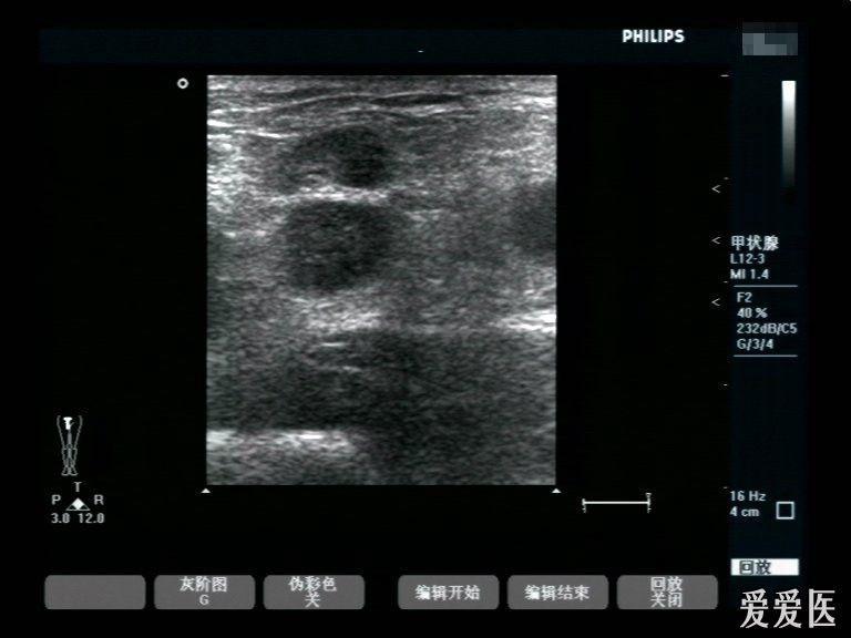 腹股溝淋巴結炎