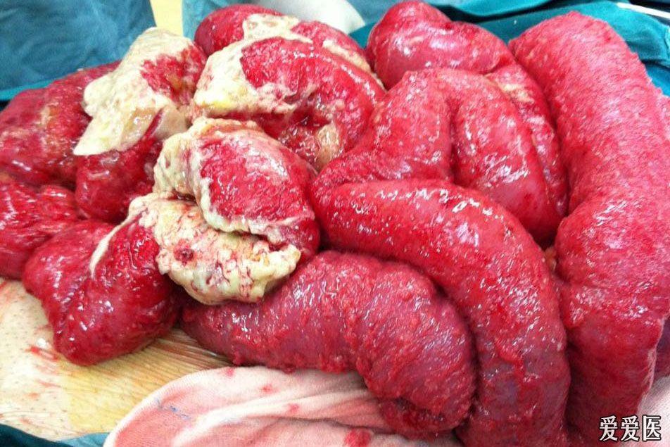 危重病腹腔感染