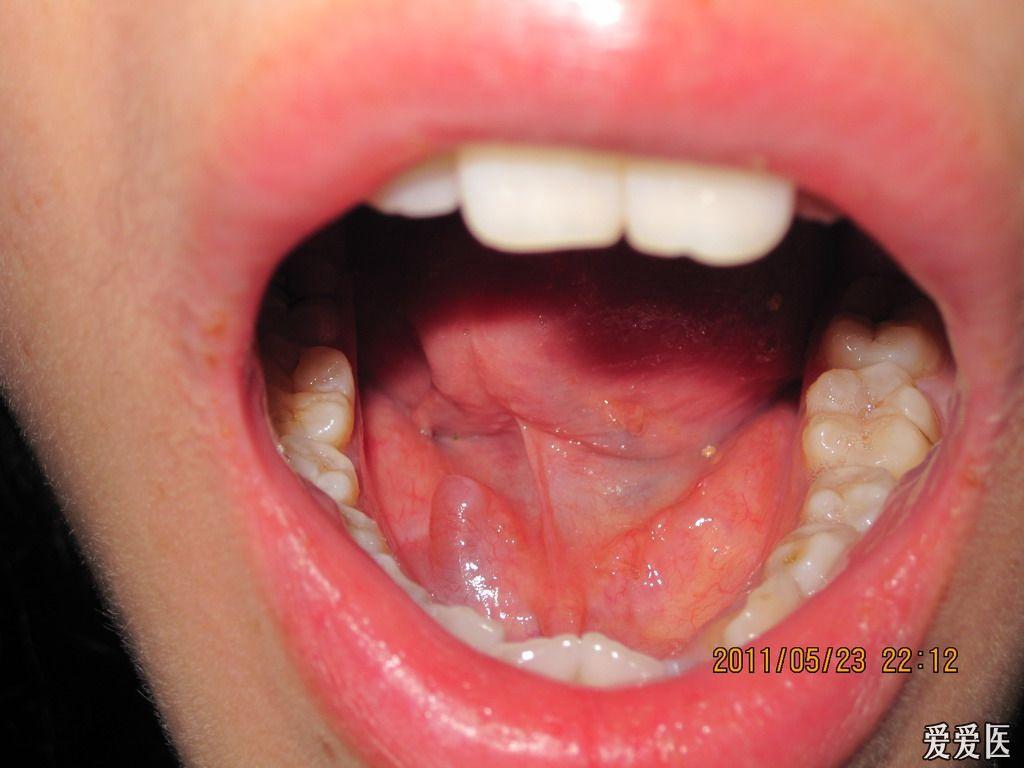 舌头系带两侧疙瘩图图片