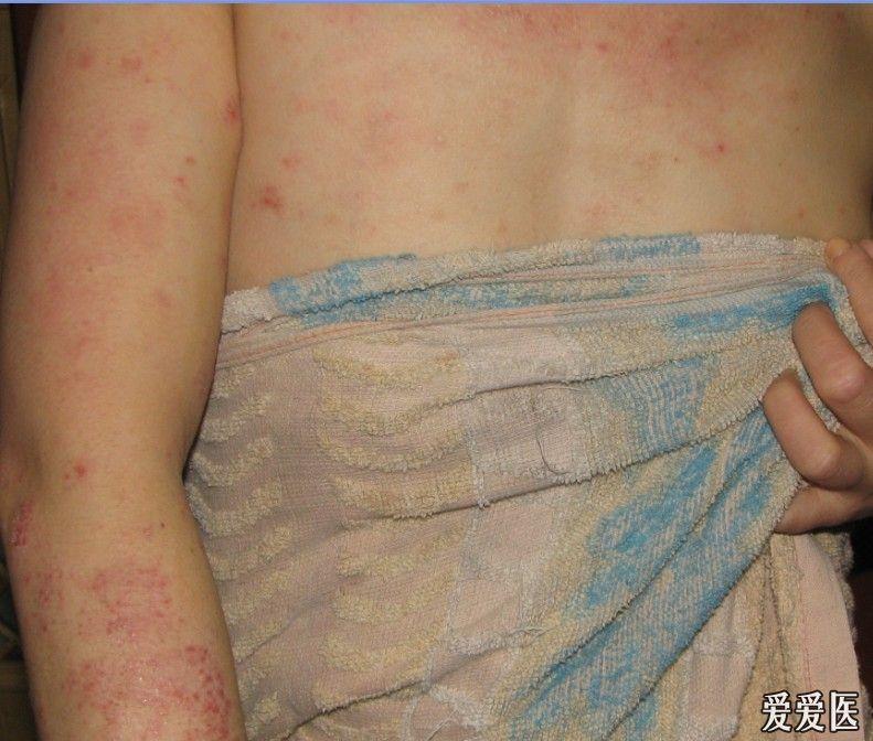 卫生院可以看荨麻疹吗 1105242100dde5c39df6cc477f.jpg