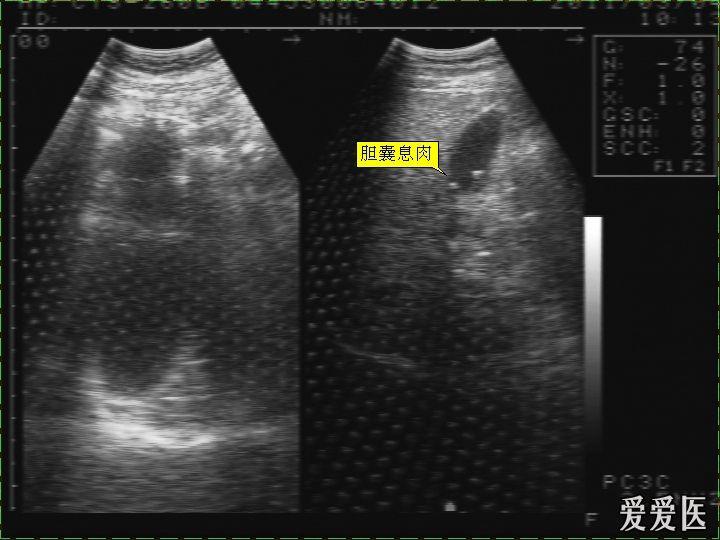 胆囊息肉彩超图片图片