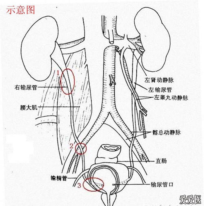 刚学 输尿管不太会打