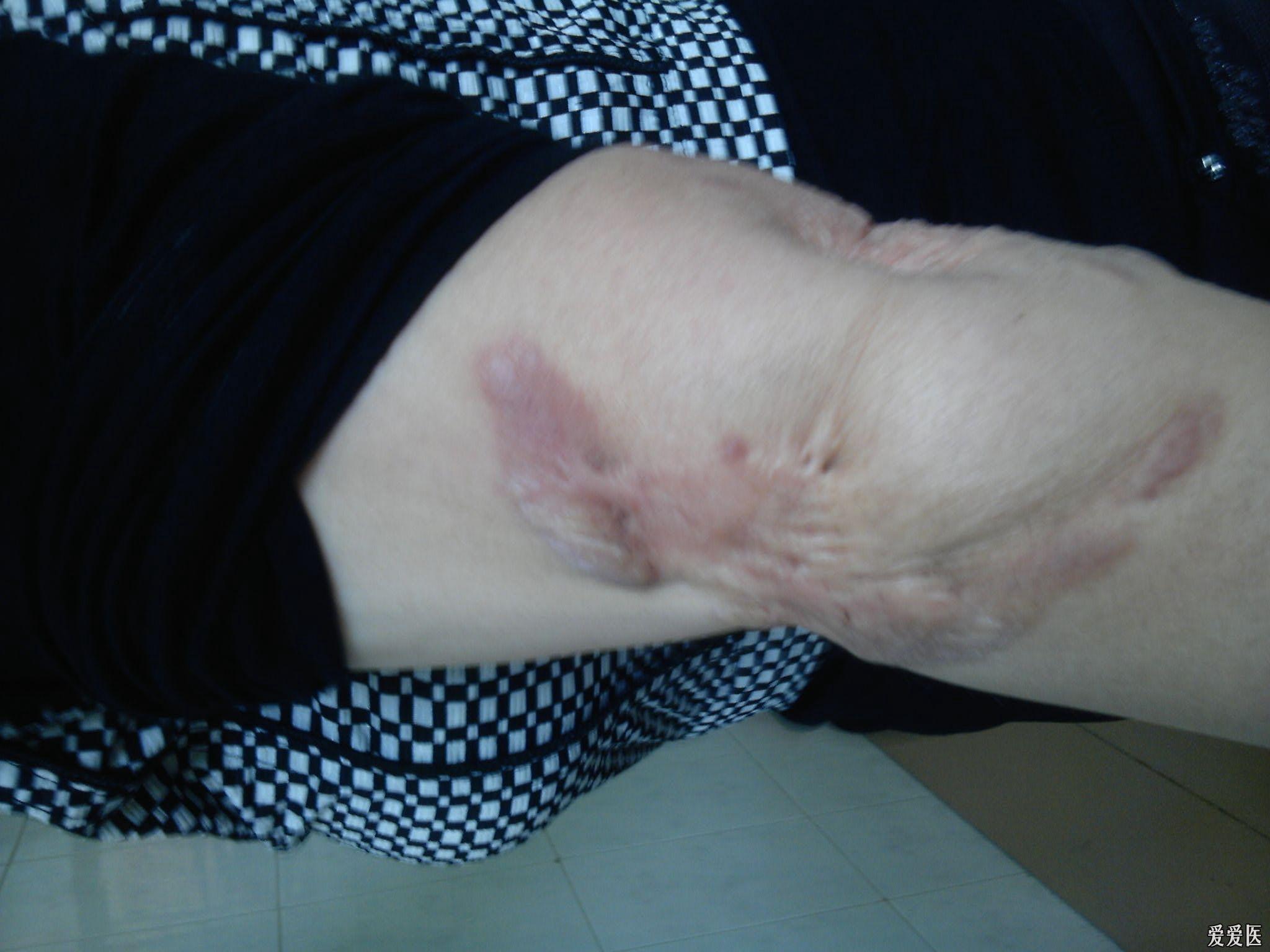 严重的疤痕体质