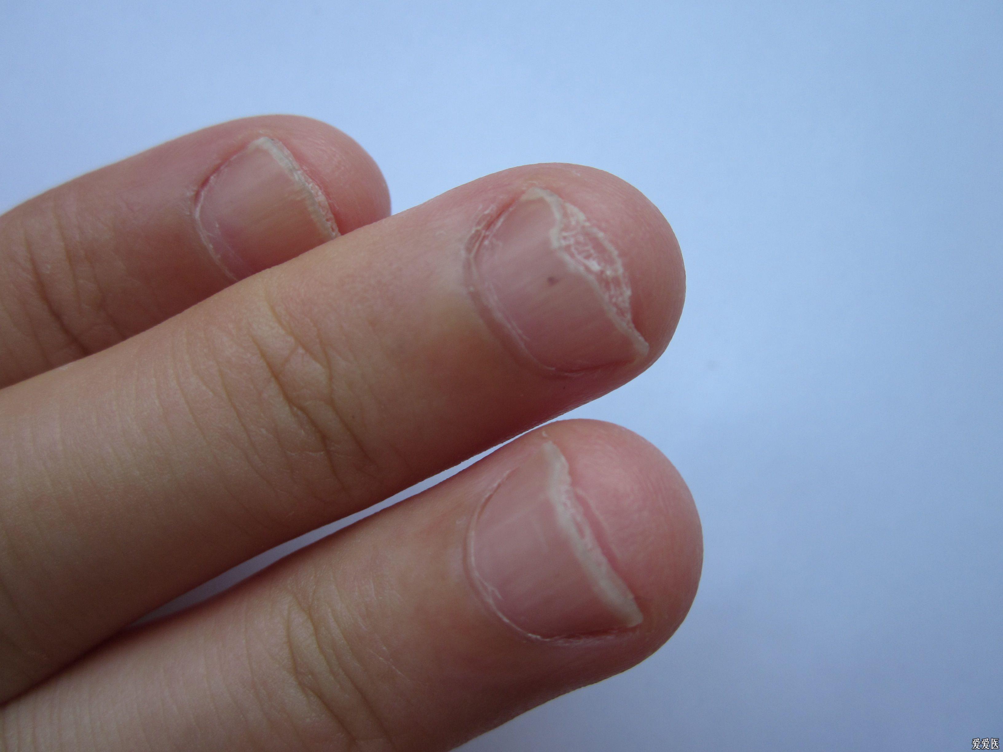 请求鉴定这是什么病指甲