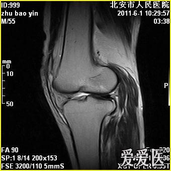 膝关节积液和髋关节积液如何治疗比较好呢内附磁共振图像