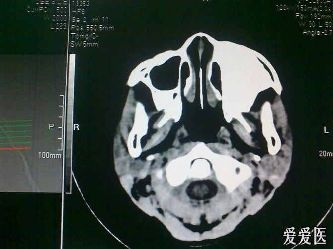 副鼻窦ct图像图片
