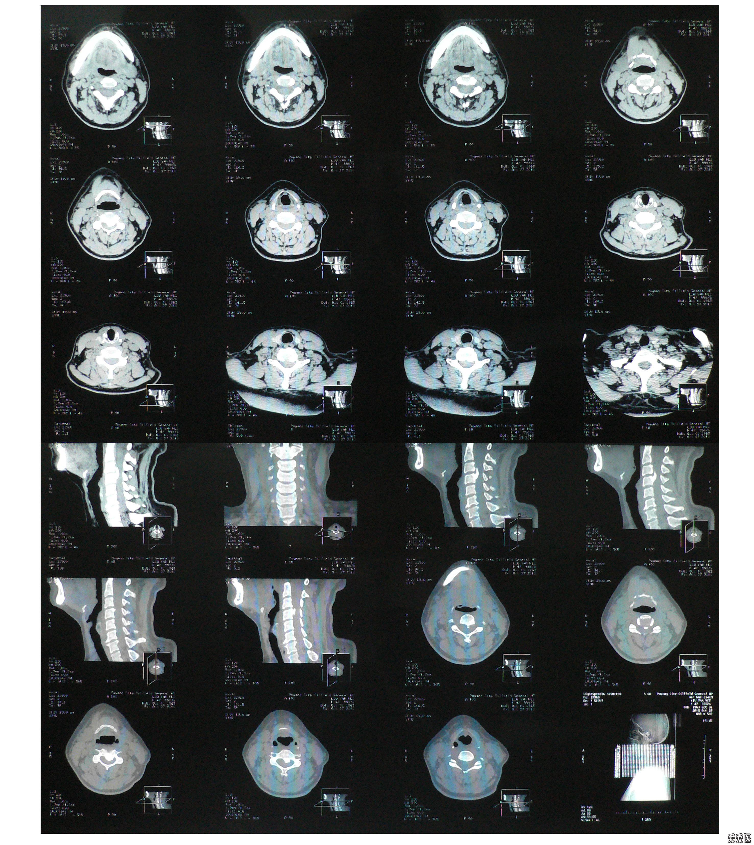 螺旋ct片子图片