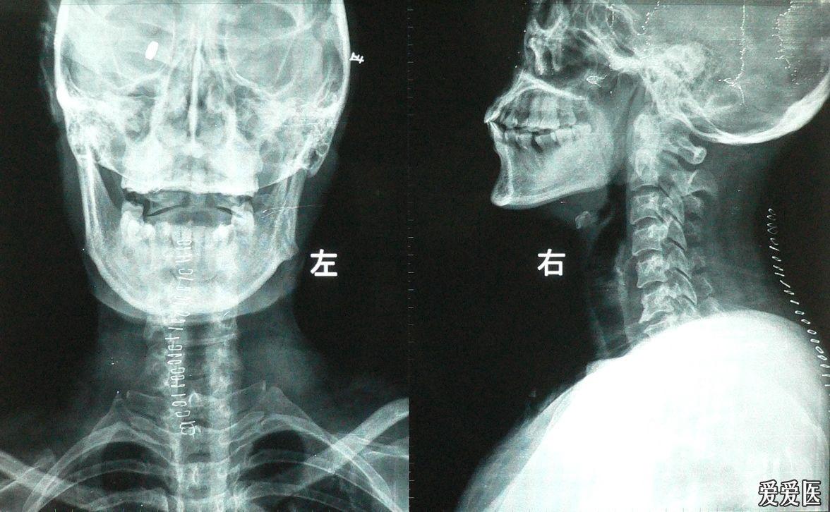 頸椎病請求上讀片會.片子上傳完畢,敬請大家出主意