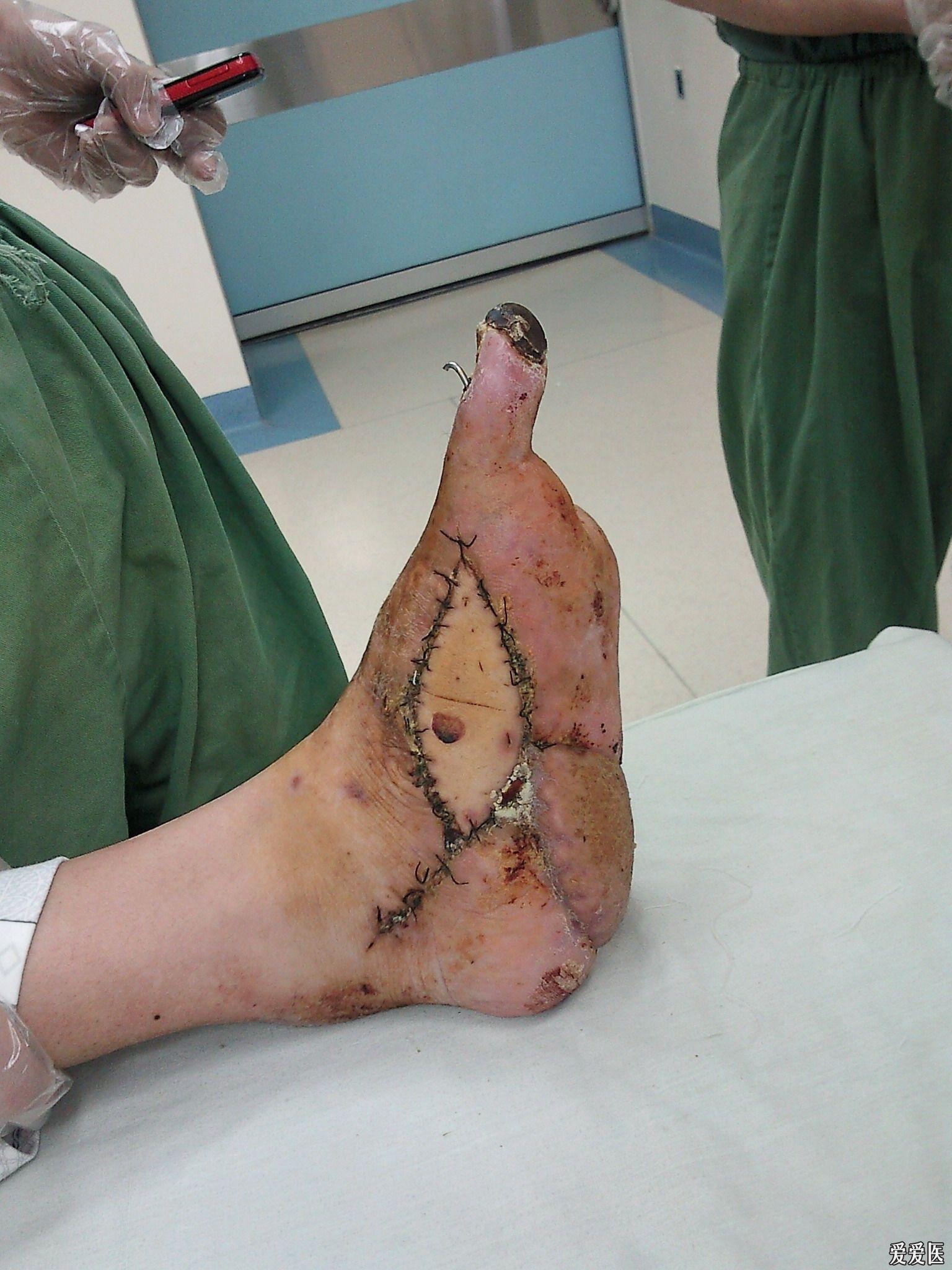左足挤压伤足内骨间肌坏死感染