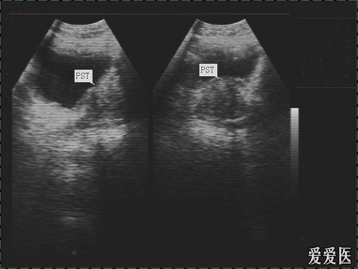 前列腺肥大 超声医学讨论版 爱爱医医学论坛