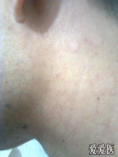 发个常见病的图下汗斑癣