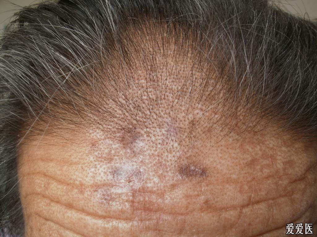 有奖猜答15病理和anaena确诊dle47人回答准确均加分