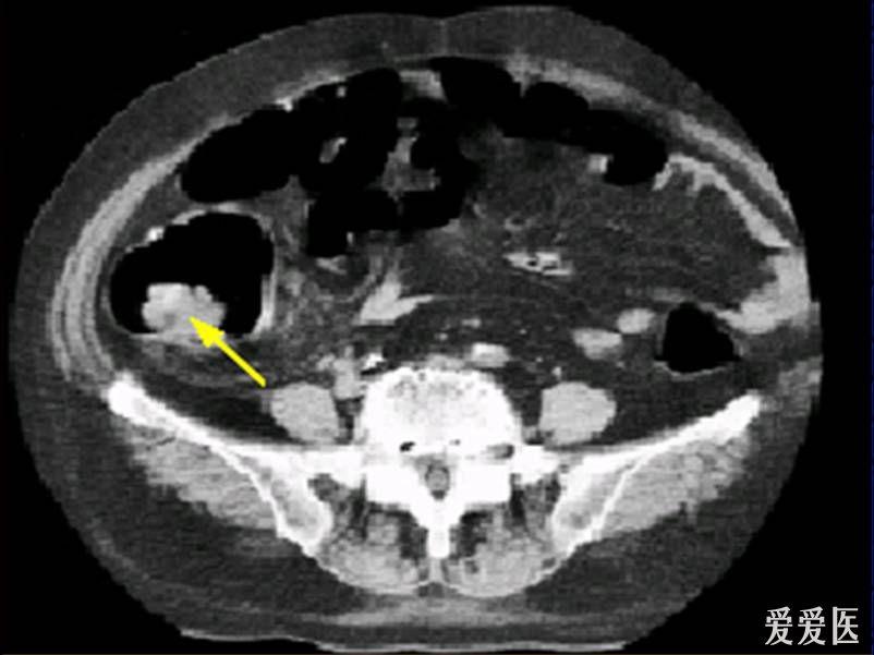 结肠癌ct表现图片图片