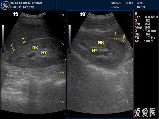 右侧输尿管结石并右肾轻度积液,右肾包膜下积液 - 超声医学讨论版