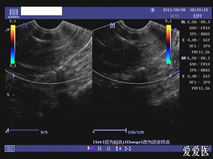 病理性缩复环超声图片图片
