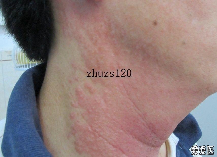 隐翅虫性皮火血管性水肿