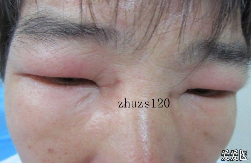 隐翅虫性皮火血管性水肿