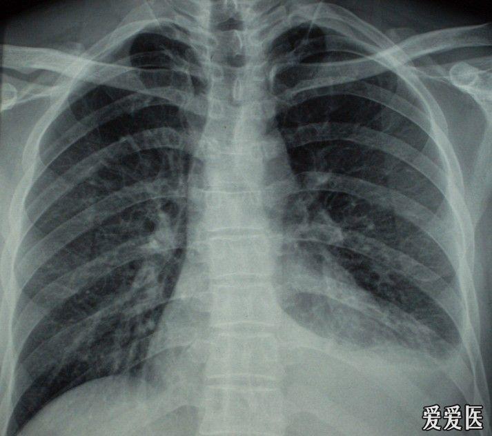 肺炎1.jpg