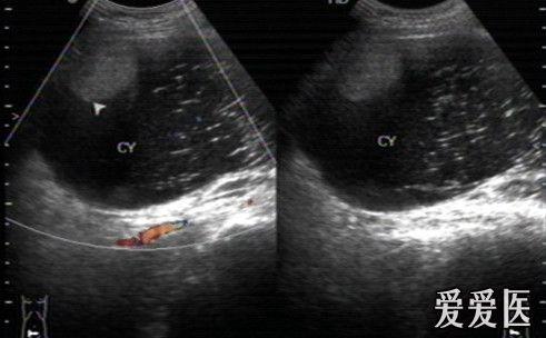 超声畸胎瘤8种声像图图片