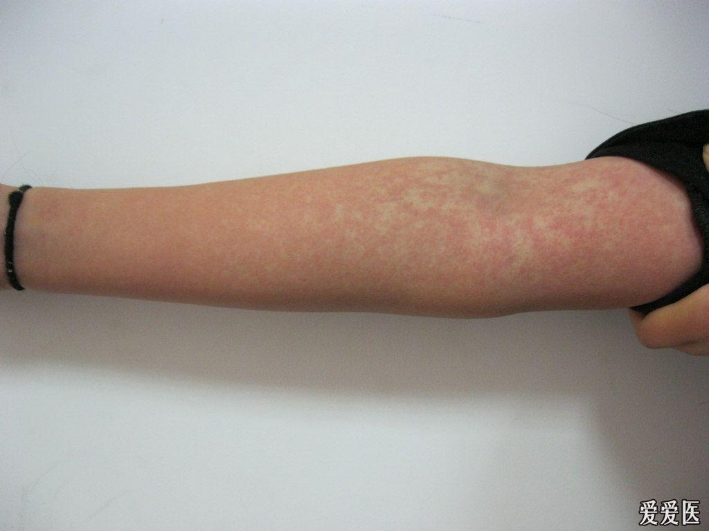 全身皮损,发热,淋巴大,脾大,肝功异常 - 皮肤及性传播疾病讨论版