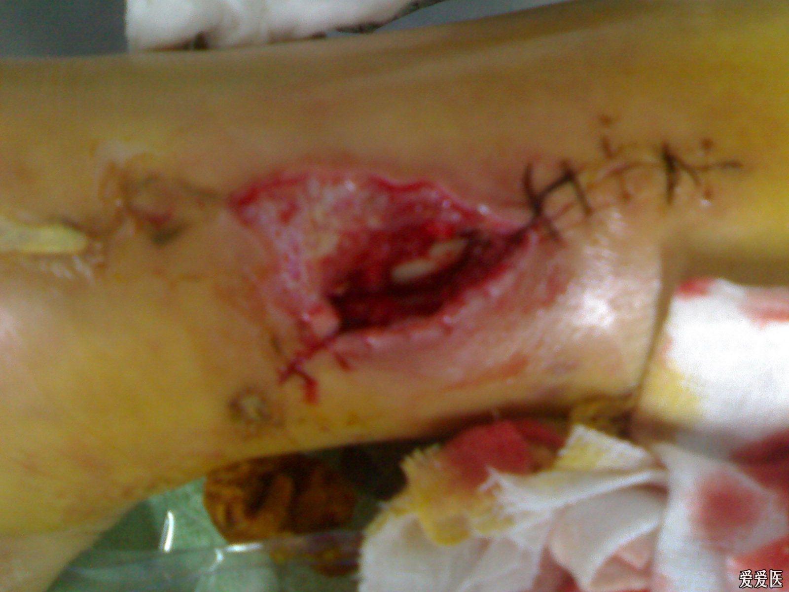 一个胫腓骨开放性骨折的病人照片