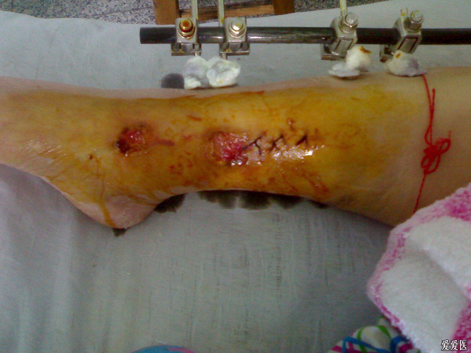 一个胫腓骨开放性骨折的病人照片