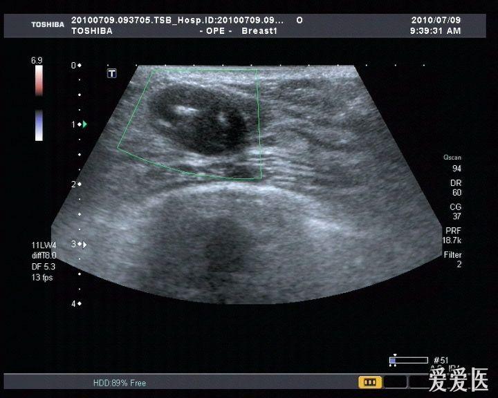乳腺纤维瘤? - 超声医学讨论版 - 爱爱医医学论坛