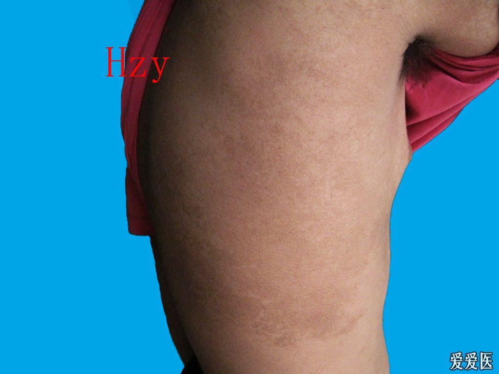 看图诊病色素性毛表皮痣