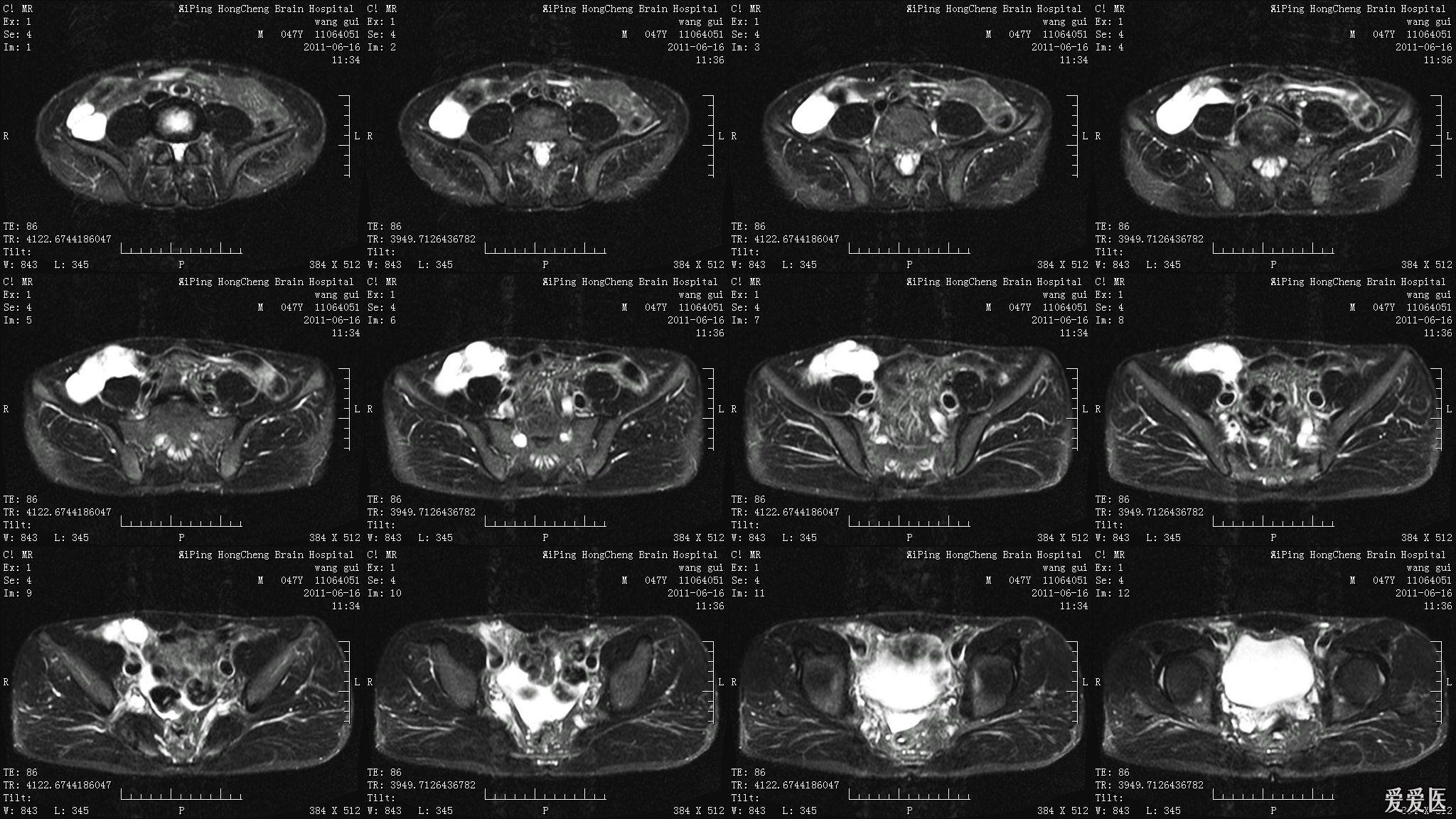 男性47岁右下腹包块mri