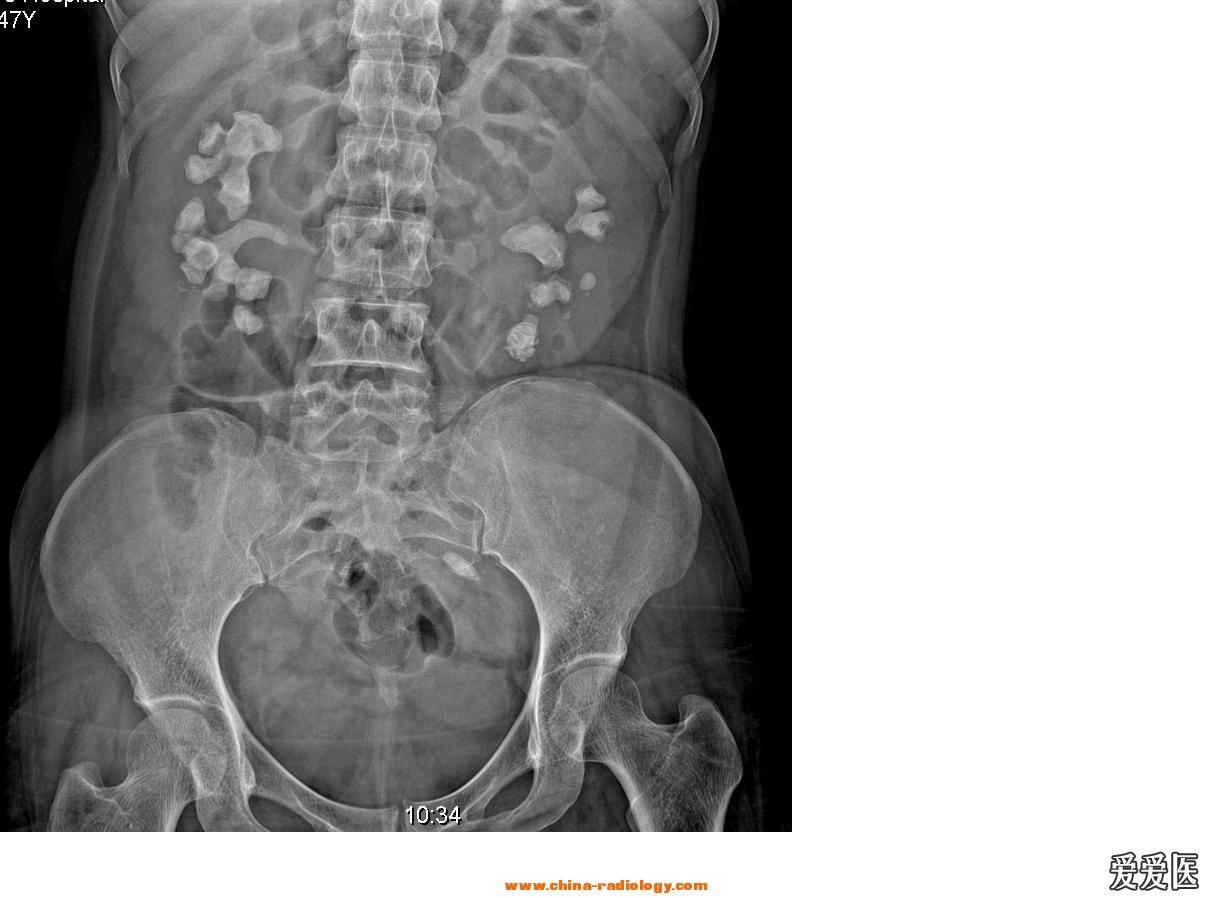 双侧肾结石(鹿角样)及左侧输尿管结石jpg