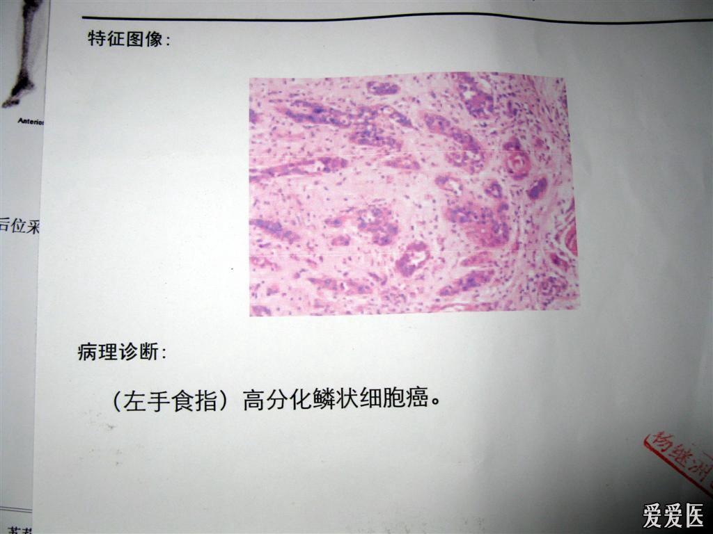 看图识病-鳞癌 皮肤及性传播疾病讨论版 爱爱医医学论坛