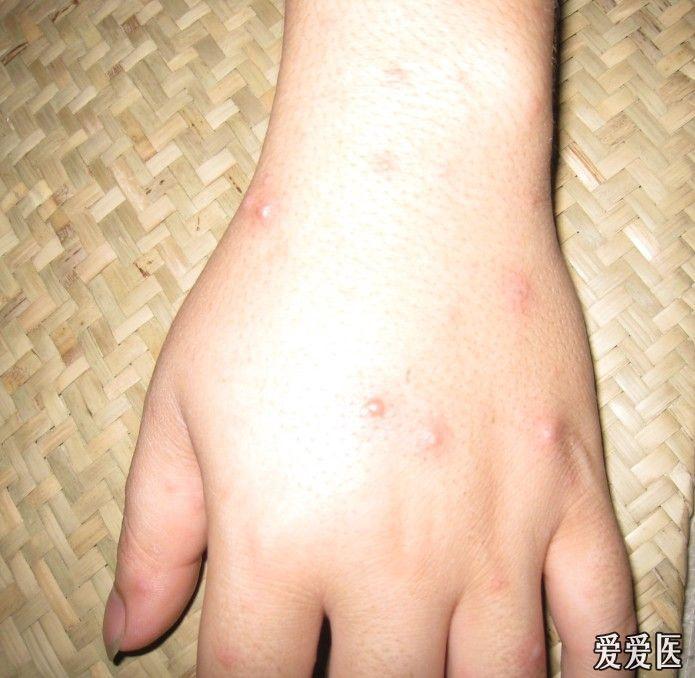 成人水痘伴感染