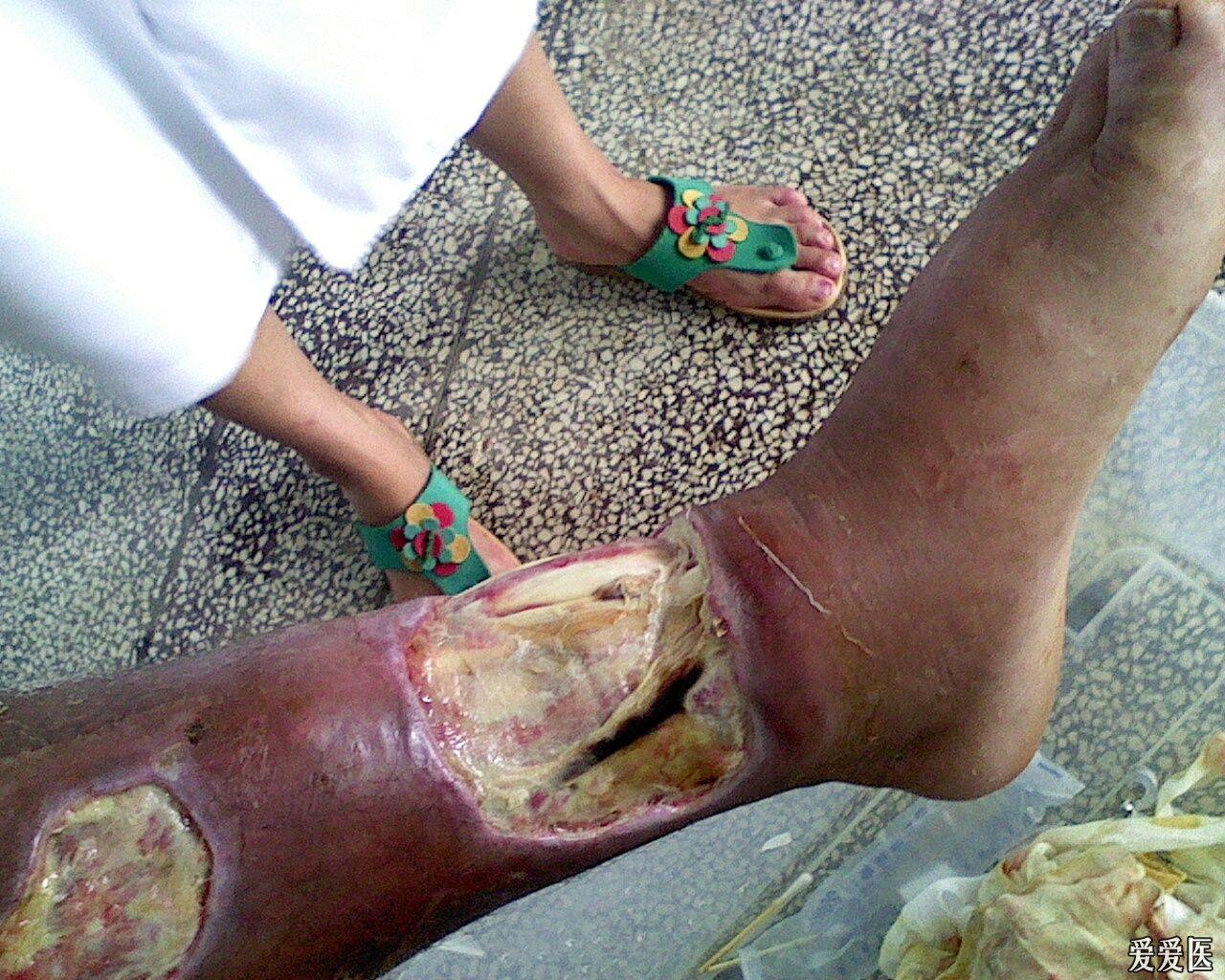 蛇咬伤导致左胫前皮肤组织缺损感染
