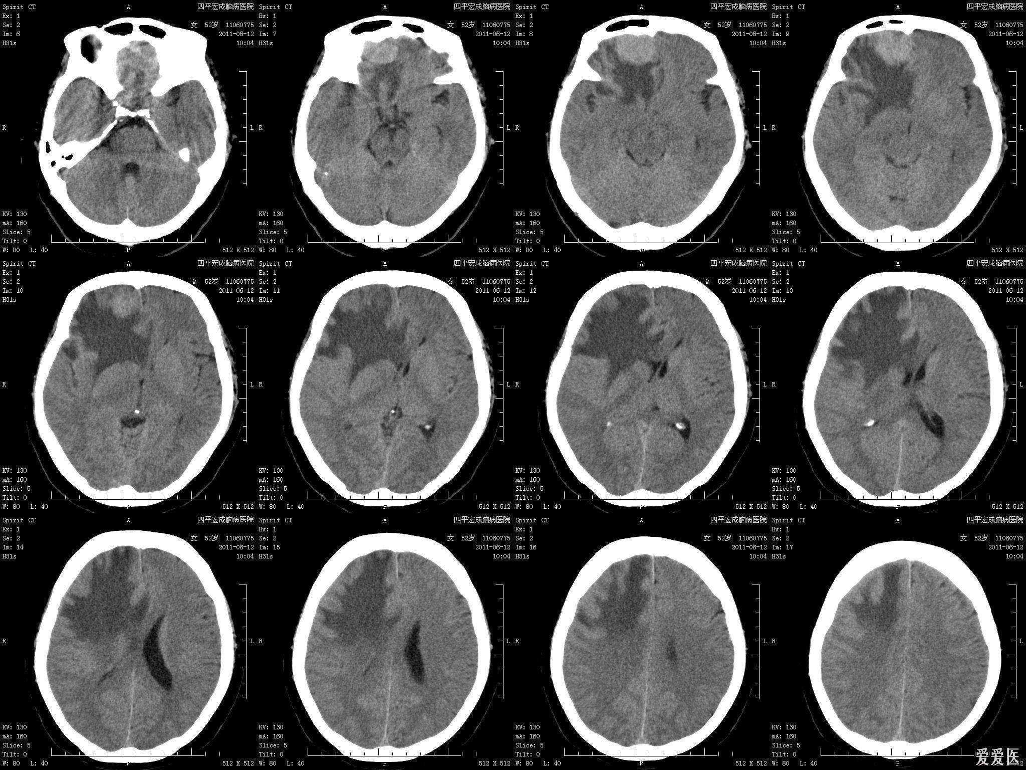 头部ct讨论之一