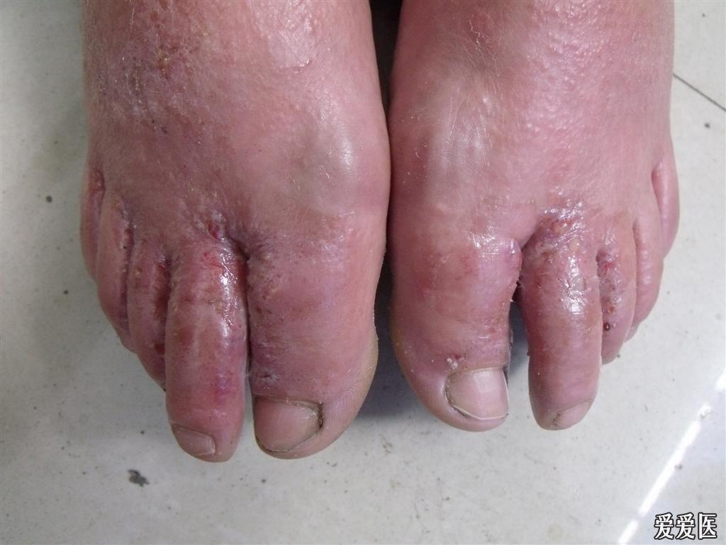足癣伴有感染