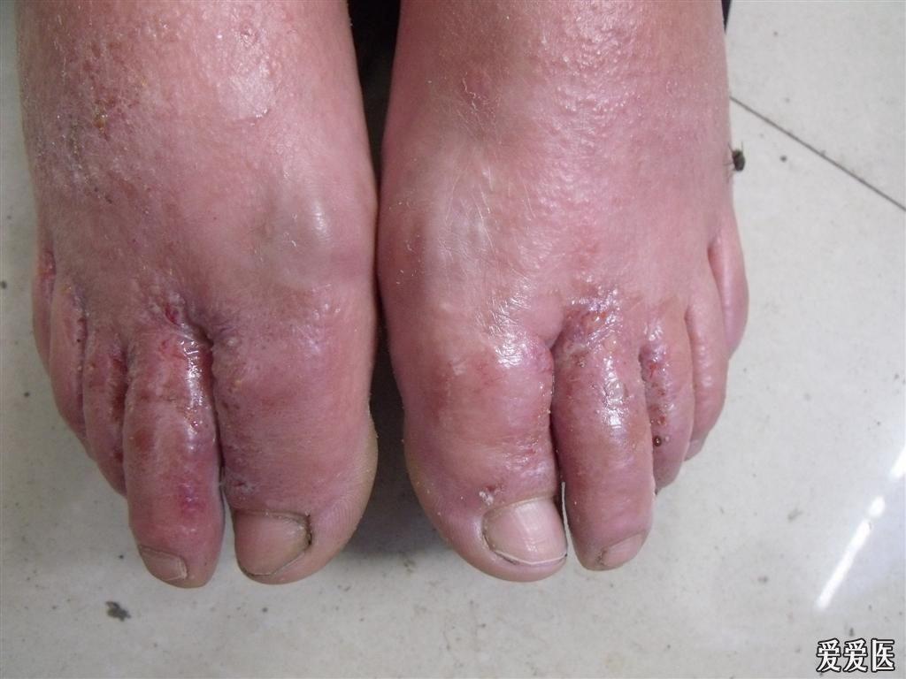 足癣伴有感染