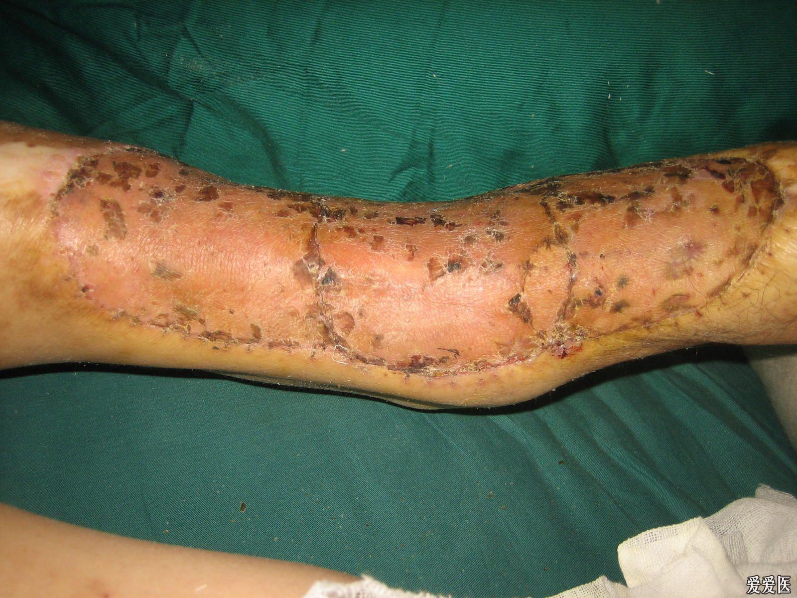 右小腿瘢痕超大溃疡三年大家来支招该怎么干