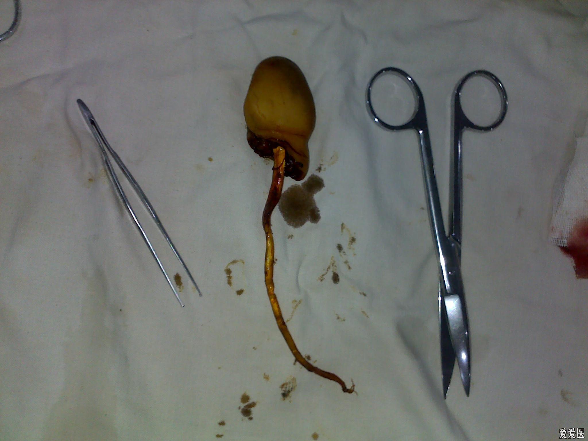 右拇趾撕脱性离断