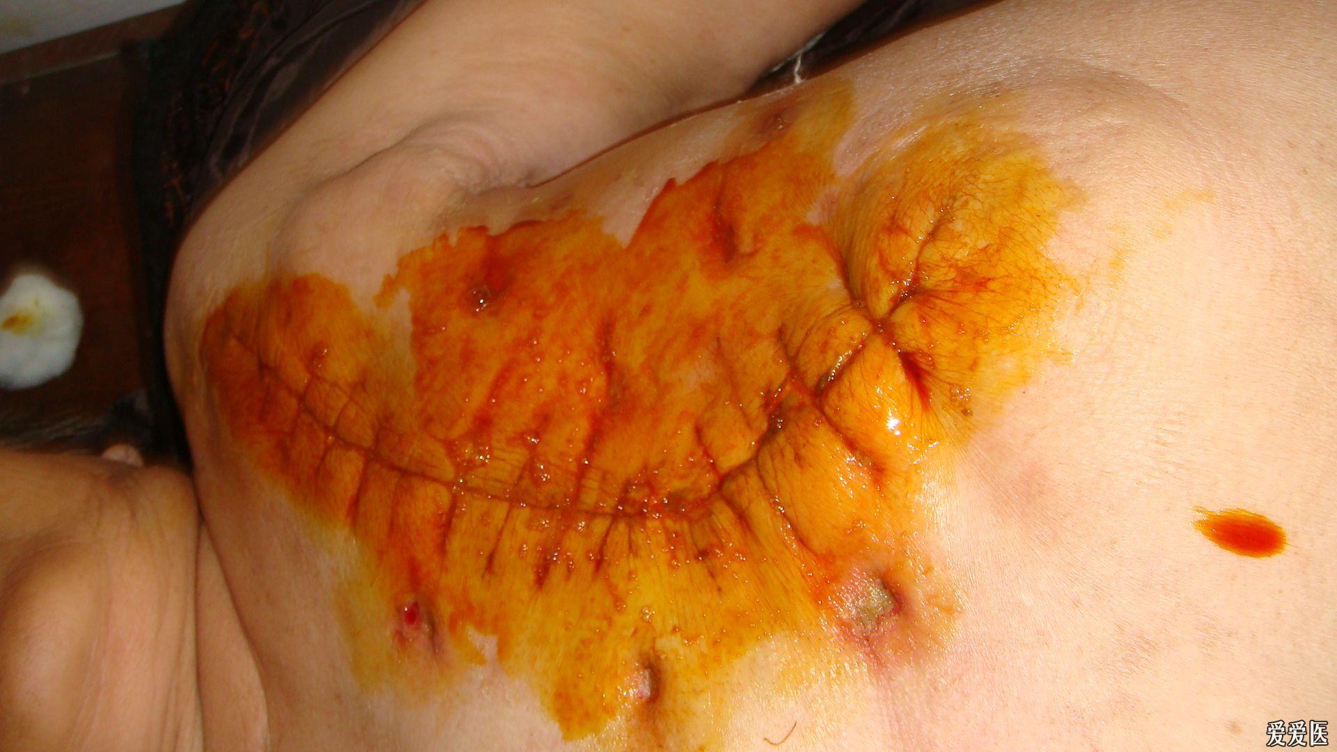 乳腺癌刀疤图片图片