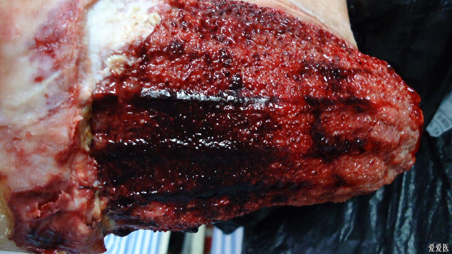 分享足跟皮瓣转移