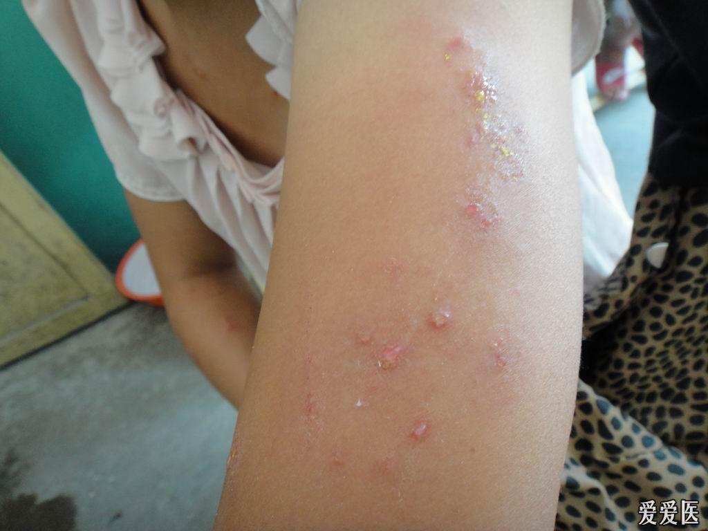 看图诊断47……自身敏感性皮炎,图片上传停止