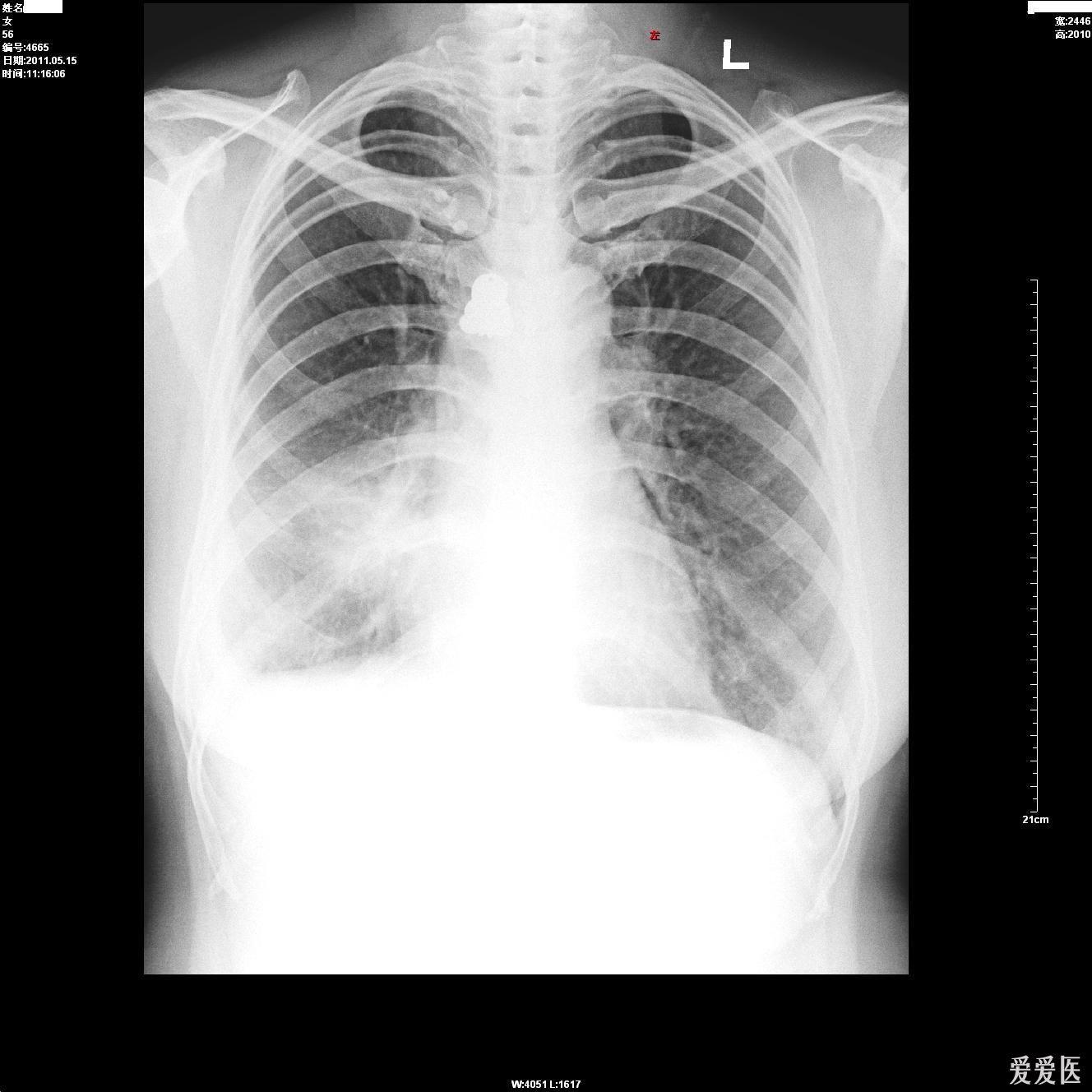 CT报告是1.双肺继发性肺结核伴双上空洞形成及支气管扩张.2.慢支,肺气肿并感染.3.双上肺大泡.还能医治好吗