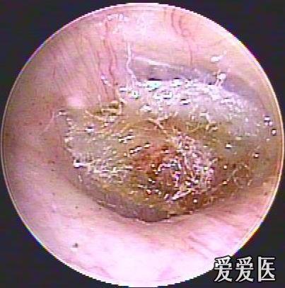 外伤性鼓膜穿孔的治疗(经验谈)