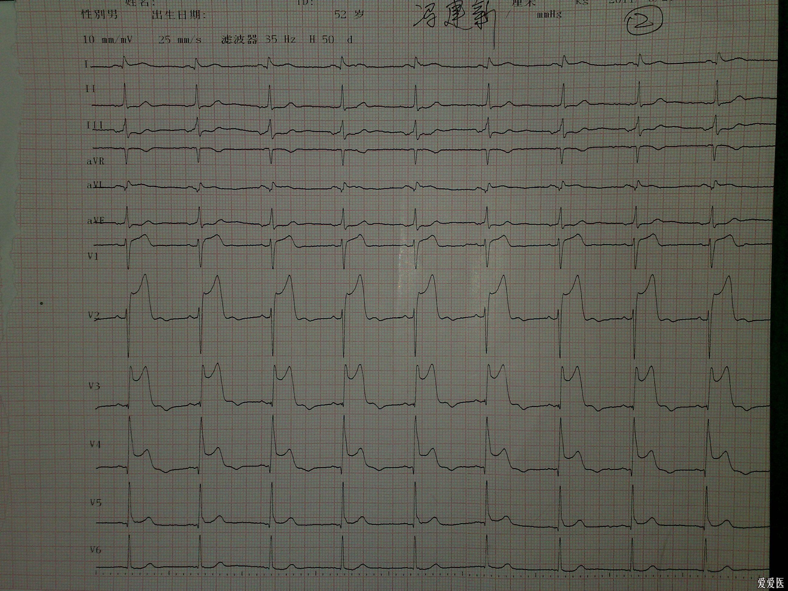 心肌梗塞的心电图片图片